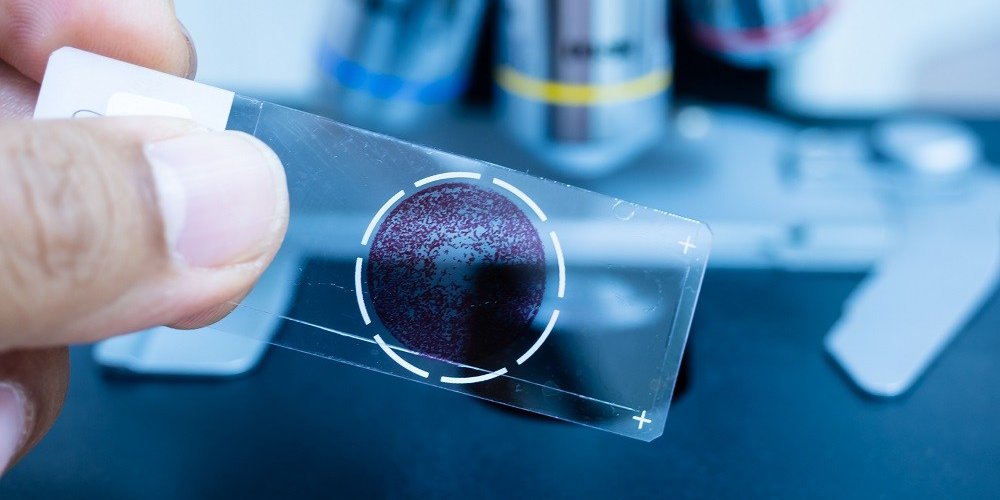 Close up of a human hand holding a microscope slide with purple stained cells and a microscope in the background.